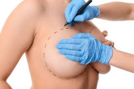 Mamoplastia