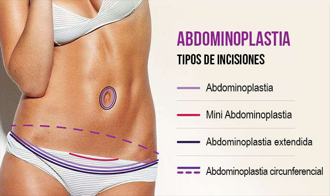 Abdominoplastia